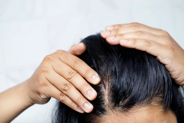 How to Improve Scalp Health Naturally